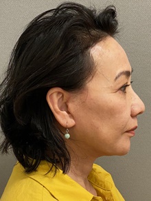 Neck Lift After Photo by Keshav Magge, MD; Bethesda, MD - Case 48133