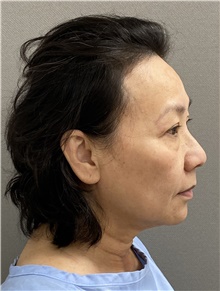 Neck Lift Before Photo by Keshav Magge, MD; Bethesda, MD - Case 48133