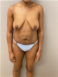 Breast Lift Before Photo by Keshav Magge, MD; Bethesda, MD - Case 48214