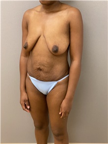 Breast Lift Before Photo by Keshav Magge, MD; Bethesda, MD - Case 48214
