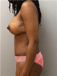 Breast Lift After Photo by Keshav Magge, MD; Bethesda, MD - Case 48214