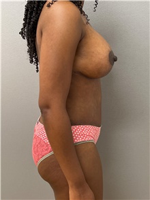 Tummy Tuck After Photo by Keshav Magge, MD; Bethesda, MD - Case 48215