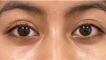 Eyelid Surgery After Photo by Keshav Magge, MD; Bethesda, MD - Case 48217