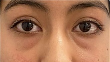 Eyelid Surgery Before Photo by Keshav Magge, MD; Bethesda, MD - Case 48217
