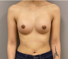 Breast Augmentation After Photo by Keshav Magge, MD; Bethesda, MD - Case 48218