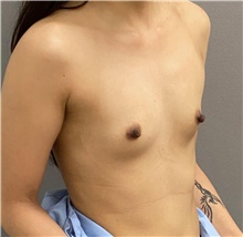 Breast Augmentation Before Photo by Keshav Magge, MD; Bethesda, MD - Case 48218