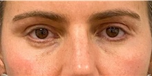 Eyelid Surgery After Photo by Keshav Magge, MD; Bethesda, MD - Case 48402