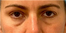 Eyelid Surgery Before Photo by Keshav Magge, MD; Bethesda, MD - Case 48402