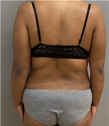 Tummy Tuck After Photo by Keshav Magge, MD; Bethesda, MD - Case 48403