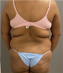 Tummy Tuck Before Photo by Keshav Magge, MD; Bethesda, MD - Case 48403