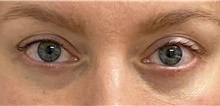 Eyelid Surgery After Photo by Keshav Magge, MD; Bethesda, MD - Case 48404