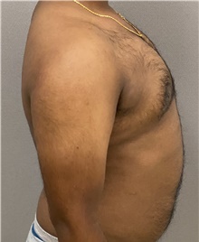 Male Breast Reduction After Photo by Keshav Magge, MD; Bethesda, MD - Case 48405