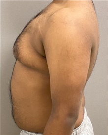Male Breast Reduction Before Photo by Keshav Magge, MD; Bethesda, MD - Case 48405