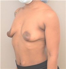 Breast Lift Before Photo by Keshav Magge, MD; Bethesda, MD - Case 48406
