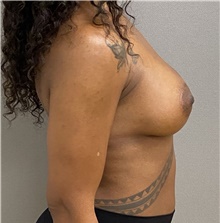 Breast Lift After Photo by Keshav Magge, MD; Bethesda, MD - Case 48406