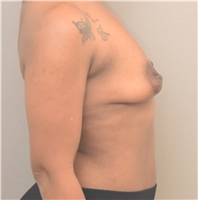 Breast Lift Before Photo by Keshav Magge, MD; Bethesda, MD - Case 48406