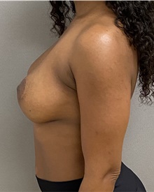 Breast Lift After Photo by Keshav Magge, MD; Bethesda, MD - Case 48406