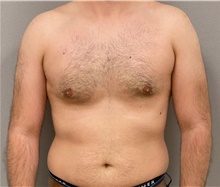 Male Breast Reduction After Photo by Keshav Magge, MD; Bethesda, MD - Case 48407