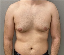 Male Breast Reduction Before Photo by Keshav Magge, MD; Bethesda, MD - Case 48407