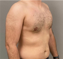 Male Breast Reduction After Photo by Keshav Magge, MD; Bethesda, MD - Case 48407