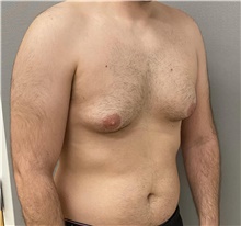 Male Breast Reduction Before Photo by Keshav Magge, MD; Bethesda, MD - Case 48407