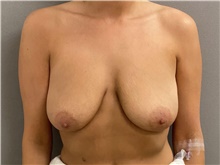 Breast Lift Before Photo by Keshav Magge, MD; Bethesda, MD - Case 48408