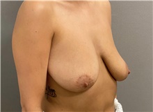 Breast Lift Before Photo by Keshav Magge, MD; Bethesda, MD - Case 48408