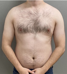 Male Breast Reduction After Photo by Keshav Magge, MD; Bethesda, MD - Case 48409