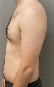 Male Breast Reduction Before Photo by Keshav Magge, MD; Bethesda, MD - Case 48409