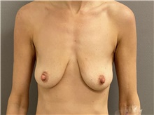 Breast Lift Before Photo by Keshav Magge, MD; Bethesda, MD - Case 48410