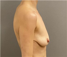 Breast Lift Before Photo by Keshav Magge, MD; Bethesda, MD - Case 48410