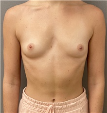 Breast Augmentation Before Photo by Keshav Magge, MD; Bethesda, MD - Case 48412