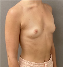 Breast Augmentation Before Photo by Keshav Magge, MD; Bethesda, MD - Case 48412