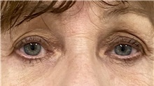 Eyelid Surgery After Photo by Keshav Magge, MD; Bethesda, MD - Case 48413