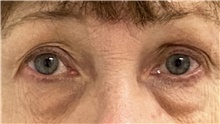 Eyelid Surgery Before Photo by Keshav Magge, MD; Bethesda, MD - Case 48413