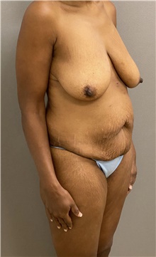 Breast Lift Before Photo by Keshav Magge, MD; Bethesda, MD - Case 48421