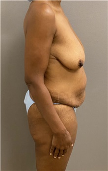 Breast Lift Before Photo by Keshav Magge, MD; Bethesda, MD - Case 48421