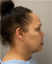 Facelift Before Photo by Keshav Magge, MD; Bethesda, MD - Case 48428