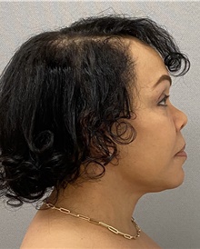 Neck Lift After Photo by Keshav Magge, MD; Bethesda, MD - Case 48429