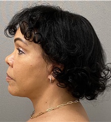 Neck Lift After Photo by Keshav Magge, MD; Bethesda, MD - Case 48429