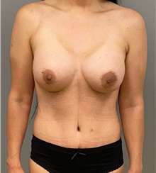 Tummy Tuck After Photo by Keshav Magge, MD; Bethesda, MD - Case 48450