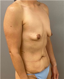 Tummy Tuck Before Photo by Keshav Magge, MD; Bethesda, MD - Case 48450