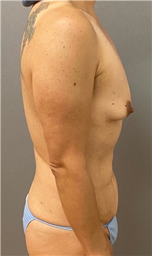Tummy Tuck Before Photo by Keshav Magge, MD; Bethesda, MD - Case 48450