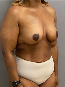 Breast Lift After Photo by Keshav Magge, MD; Bethesda, MD - Case 48453