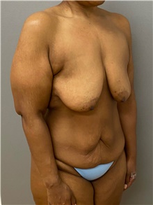 Breast Lift Before Photo by Keshav Magge, MD; Bethesda, MD - Case 48453