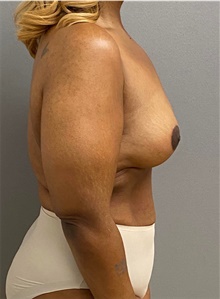 Breast Lift After Photo by Keshav Magge, MD; Bethesda, MD - Case 48453