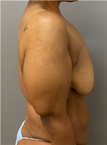 Breast Lift Before Photo by Keshav Magge, MD; Bethesda, MD - Case 48453
