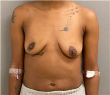 Breast Augmentation Before Photo by Keshav Magge, MD; Bethesda, MD - Case 48454