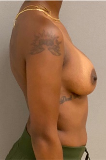 Breast Augmentation After Photo by Keshav Magge, MD; Bethesda, MD - Case 48454