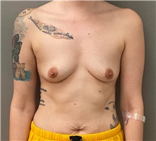 Breast Augmentation Before Photo by Keshav Magge, MD; Bethesda, MD - Case 48455